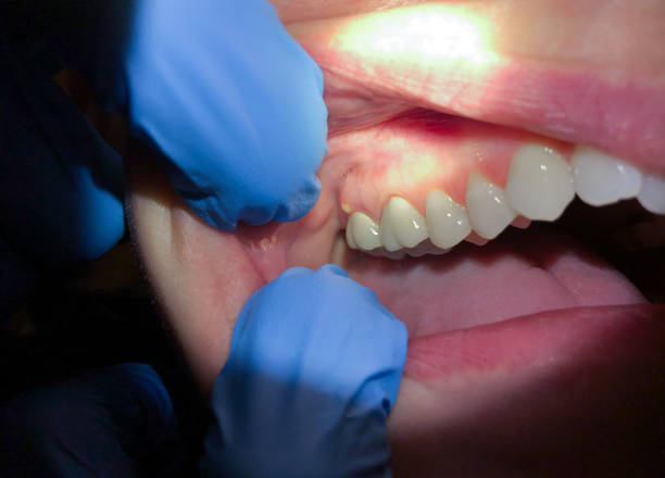 Best Emergency Tooth Extraction in Mechanicsburg, OH